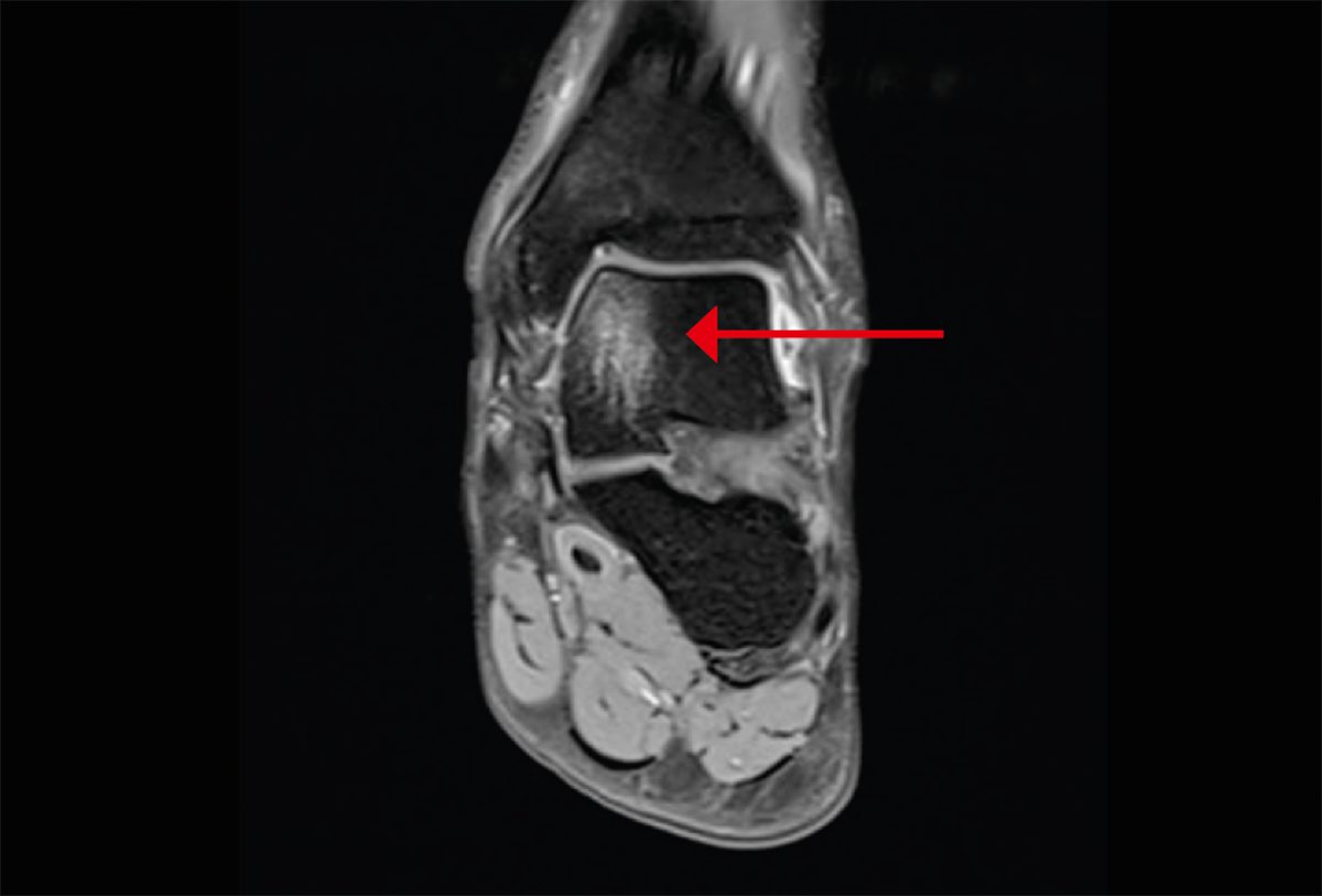 Cartilage/bone lesions Sportärztezeitung