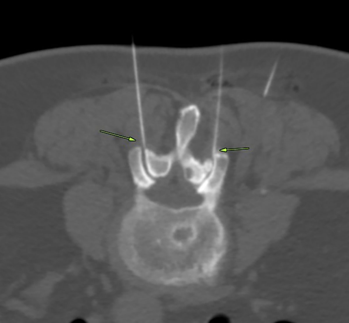 Schmerztherapie an der Wirbelsäule