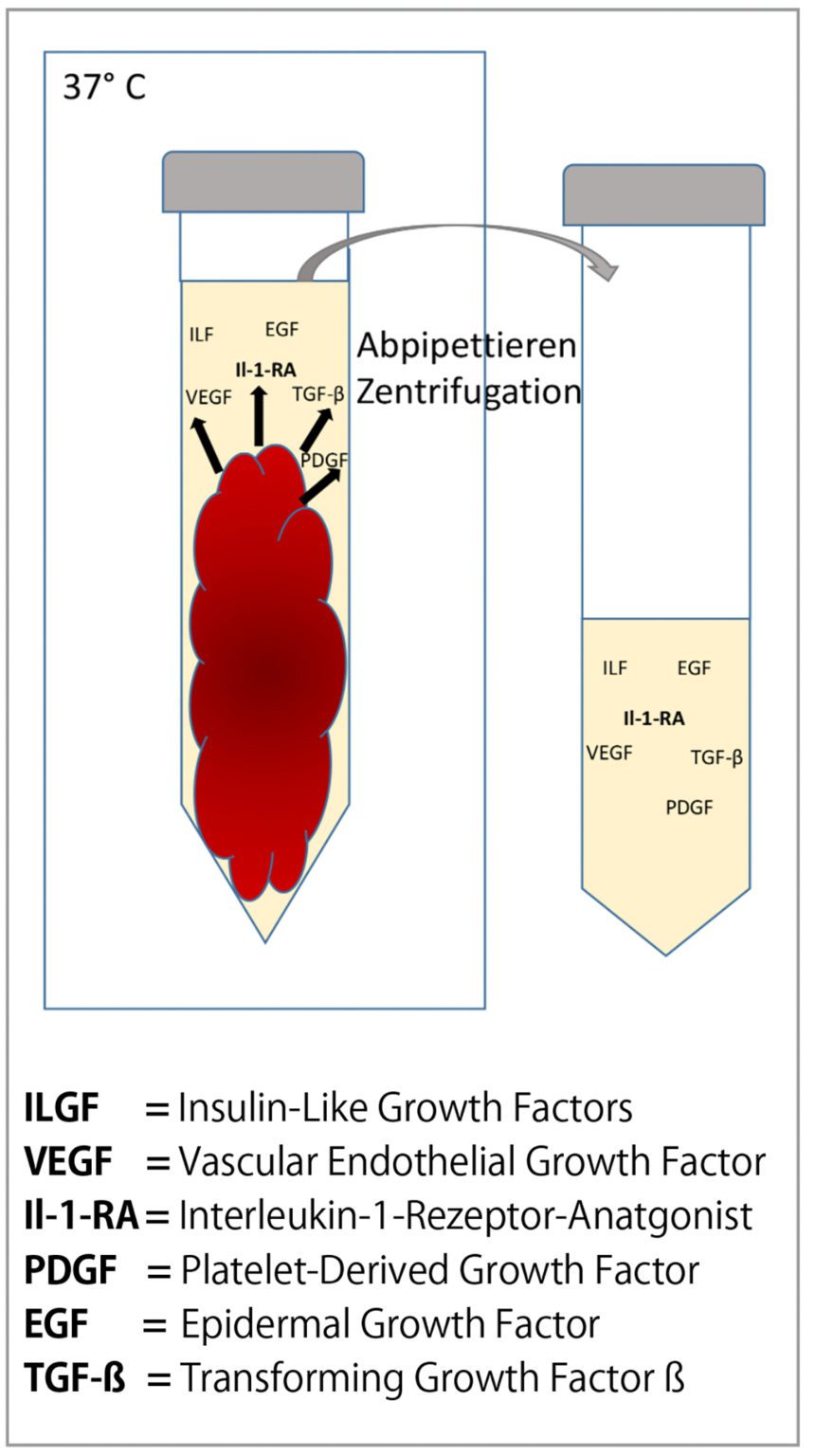 PRP, ACS, BCS - Sportärztezeitung Blutderivate Injektion