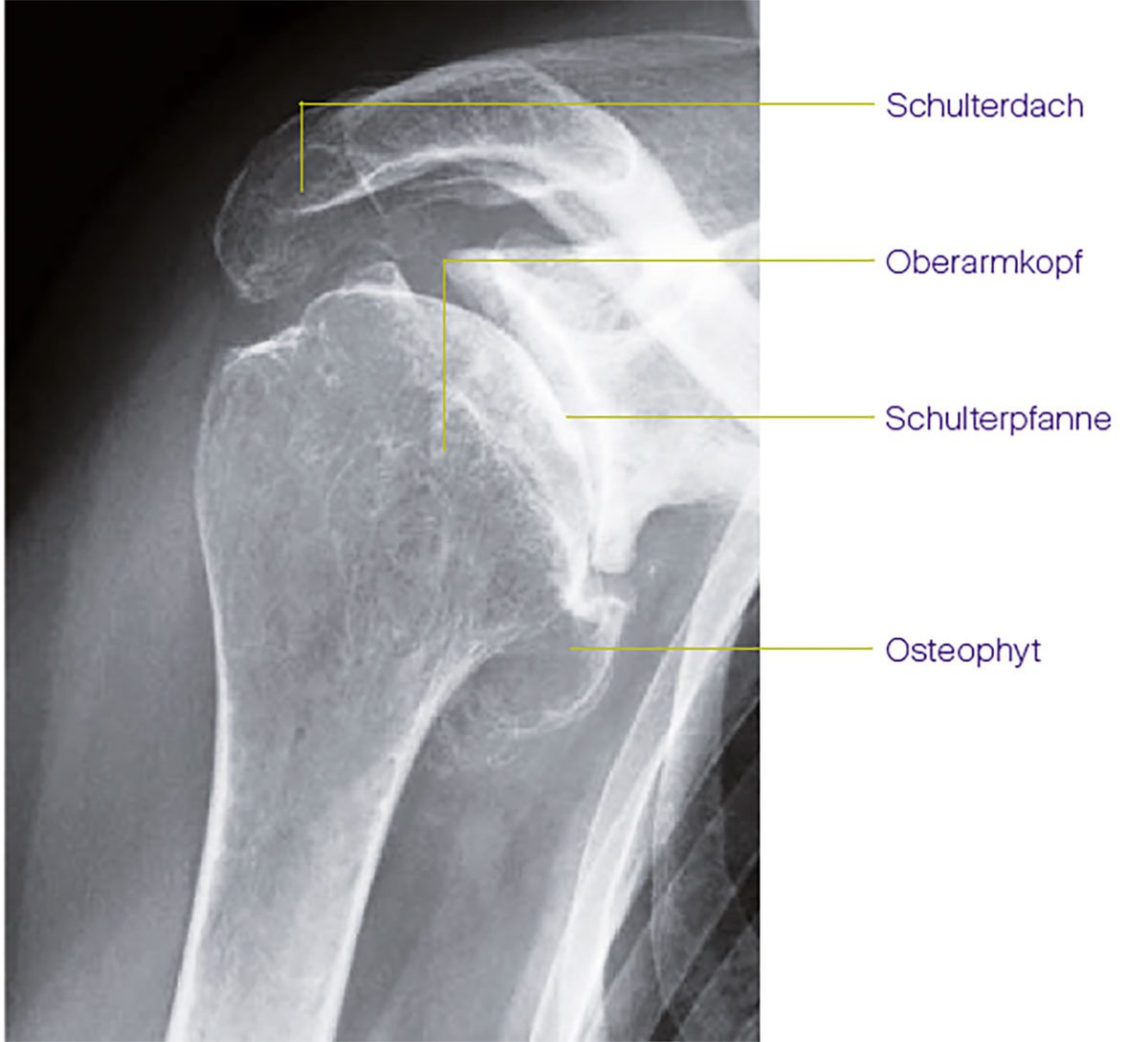 Arthrose in der Schulter sportärztezeitung
