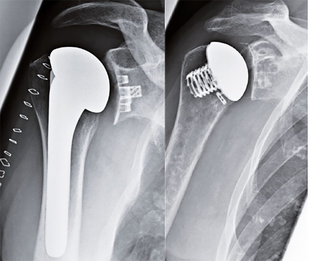 Prothese Inverser Arthrose in der Schulter