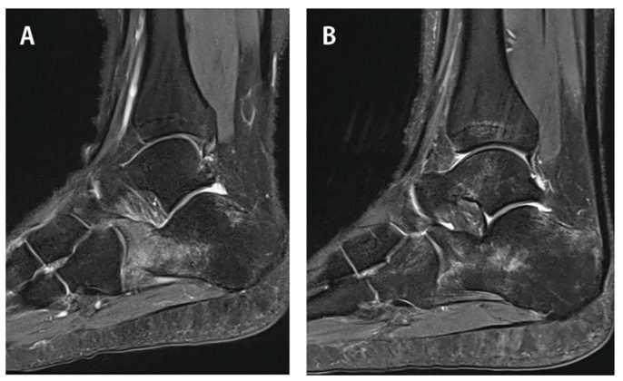 Arthrose - Ursachen, Diagnostik Und Therapie Sportärztezeitung