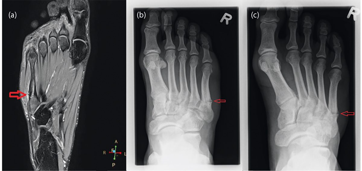 acute-and-stress-metatarsal-fractures-in-sport-sport-rztezeitung