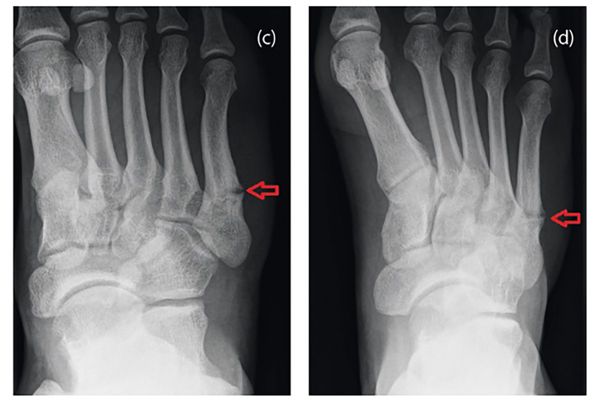 Acute and stress metatarsal fractures in sport sportärztezeitung