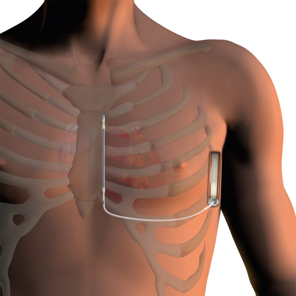 Substernal Pacemaker Subkutaner Intracardialer Defibrillator (S-ICD)