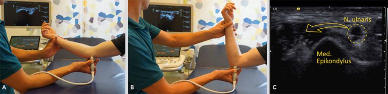 Sonographie Der Schulter Und Ellenbogen sonographie-der-schulter-und-ellenbogen