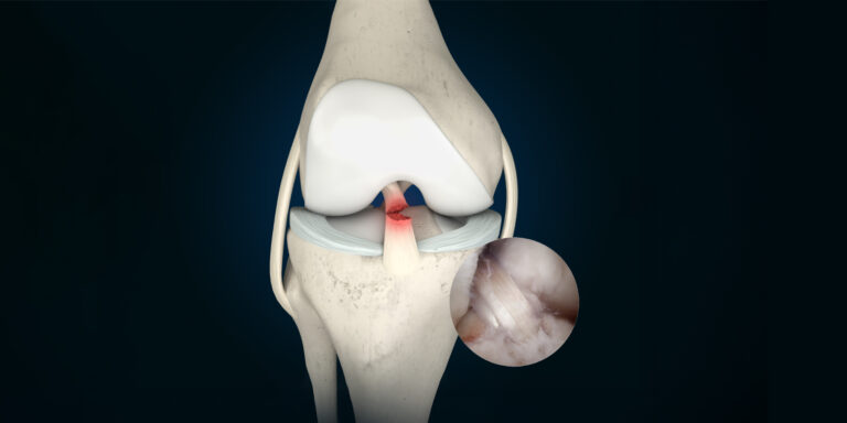 Kreuzbandtransplantat