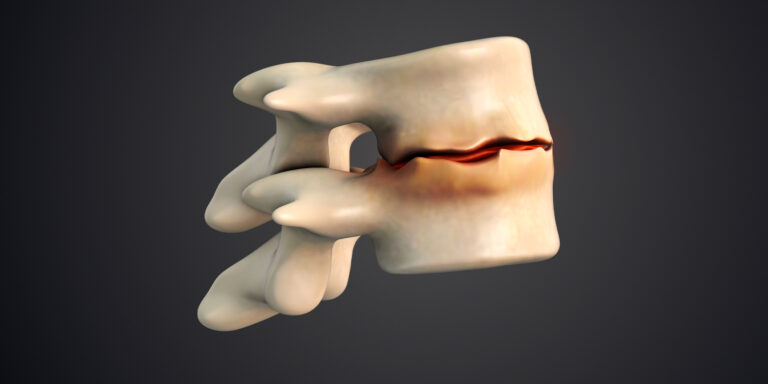 Oxidativer Stress und Bandscheibendegeneration